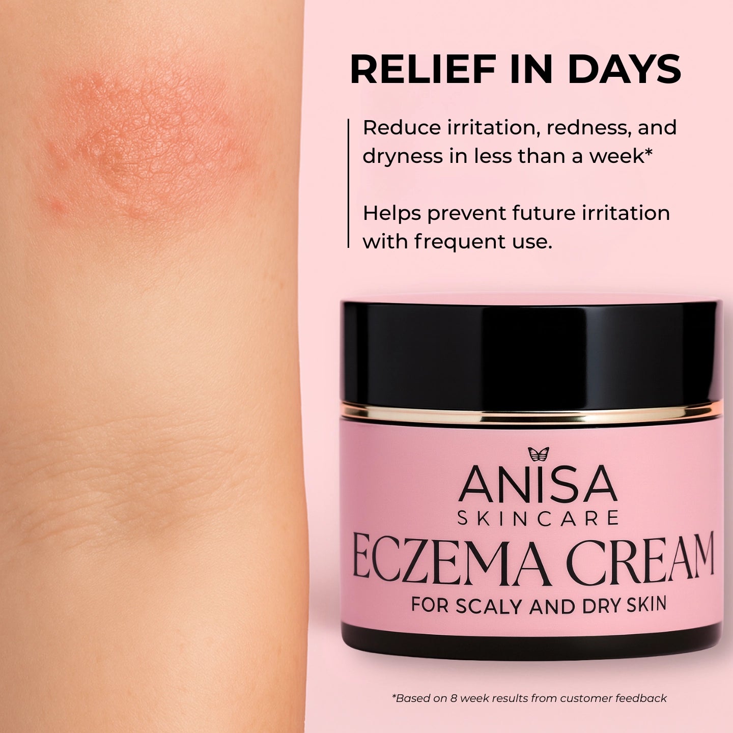 CalmDerm™ Eczema Cream