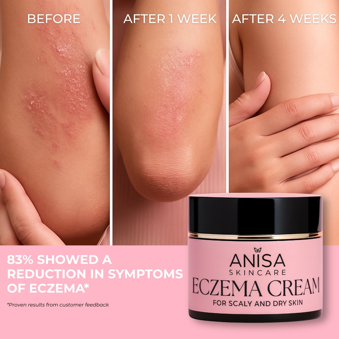 CalmDerm™ Eczema Cream