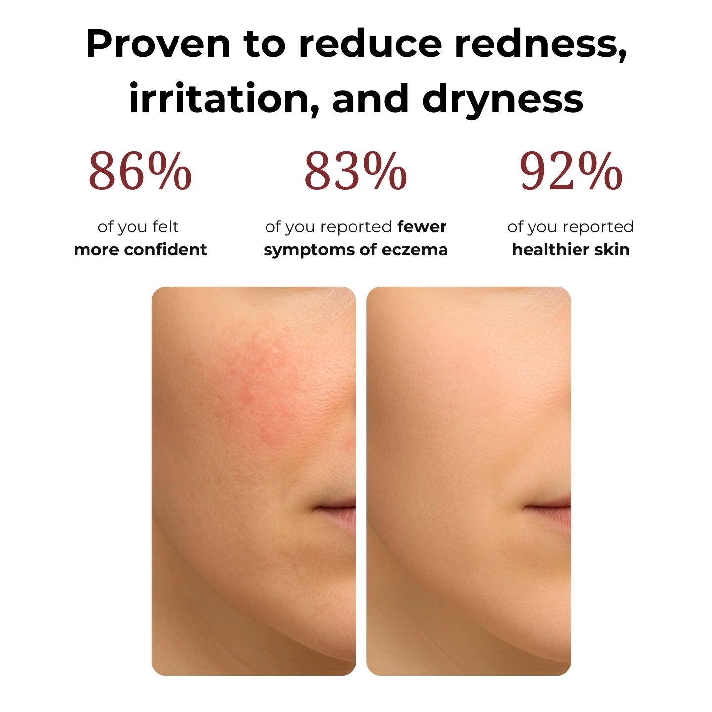 CalmDerm™ Eczema Cream