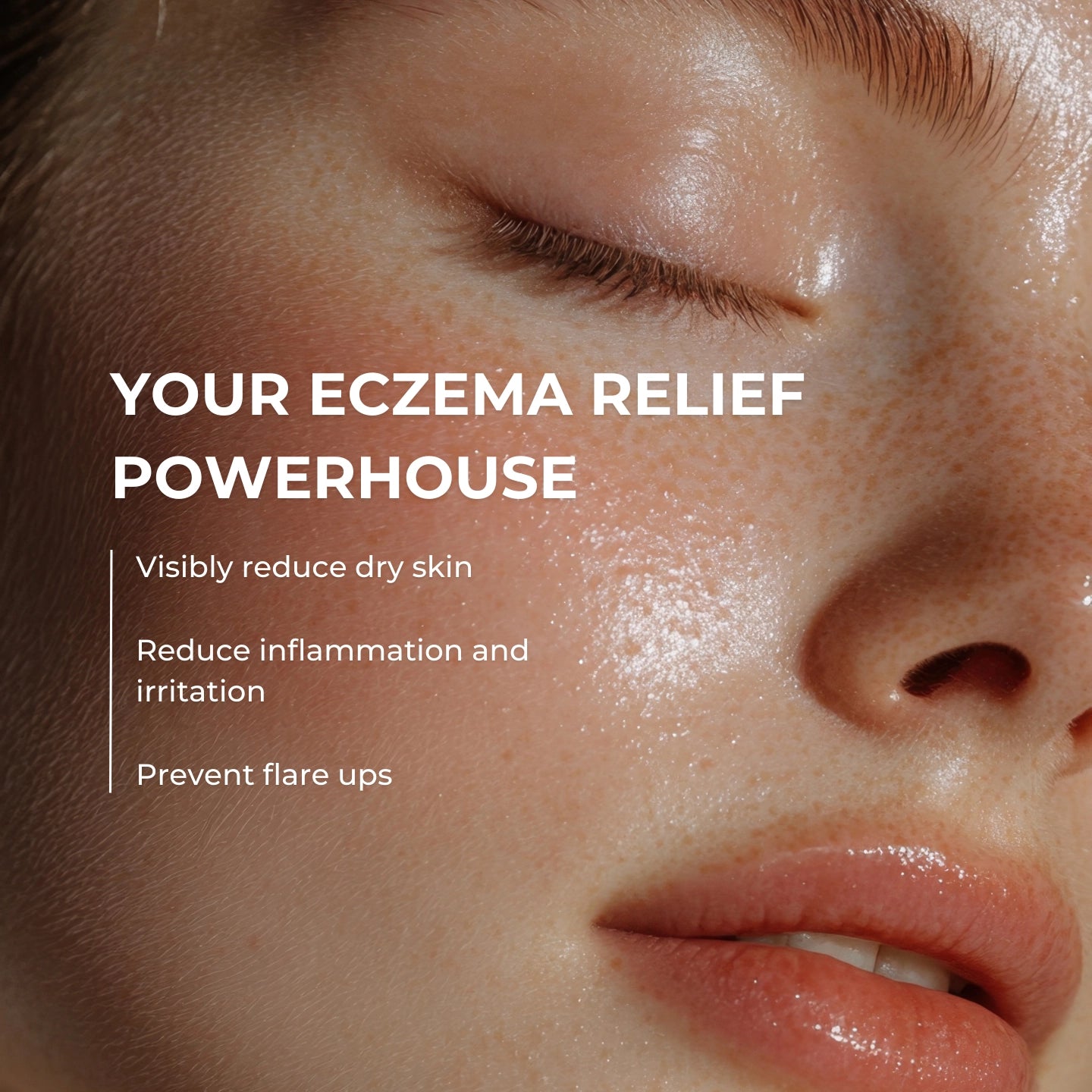 CalmDerm™ Eczema Cream